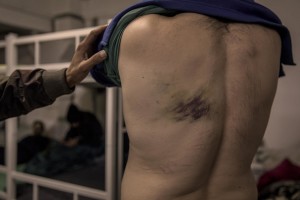 A migrant shows the wound caused by the beating by Croatian police while he was trying to cross the border between Bosnia and Croatia inside the Velika Kladusa refugee camp, in Bosnia and Herzegovina on November 30, 2018.