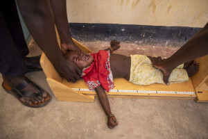 A malnourished child cries as some doctors measure his height at the Chok Chok dispensary, located in Turkana County, northwest Kenya on October 14, 2024. The Chok Chok dispensary was founded in 2016 by the Turkana Country Government and thanks to the “Nutrition Program” once a week it welcomes women and children from the surrounding villages to provide them with medicines, food supplements and to monitor their health conditions, which are put at risk by the severe drought that is affecting the country.